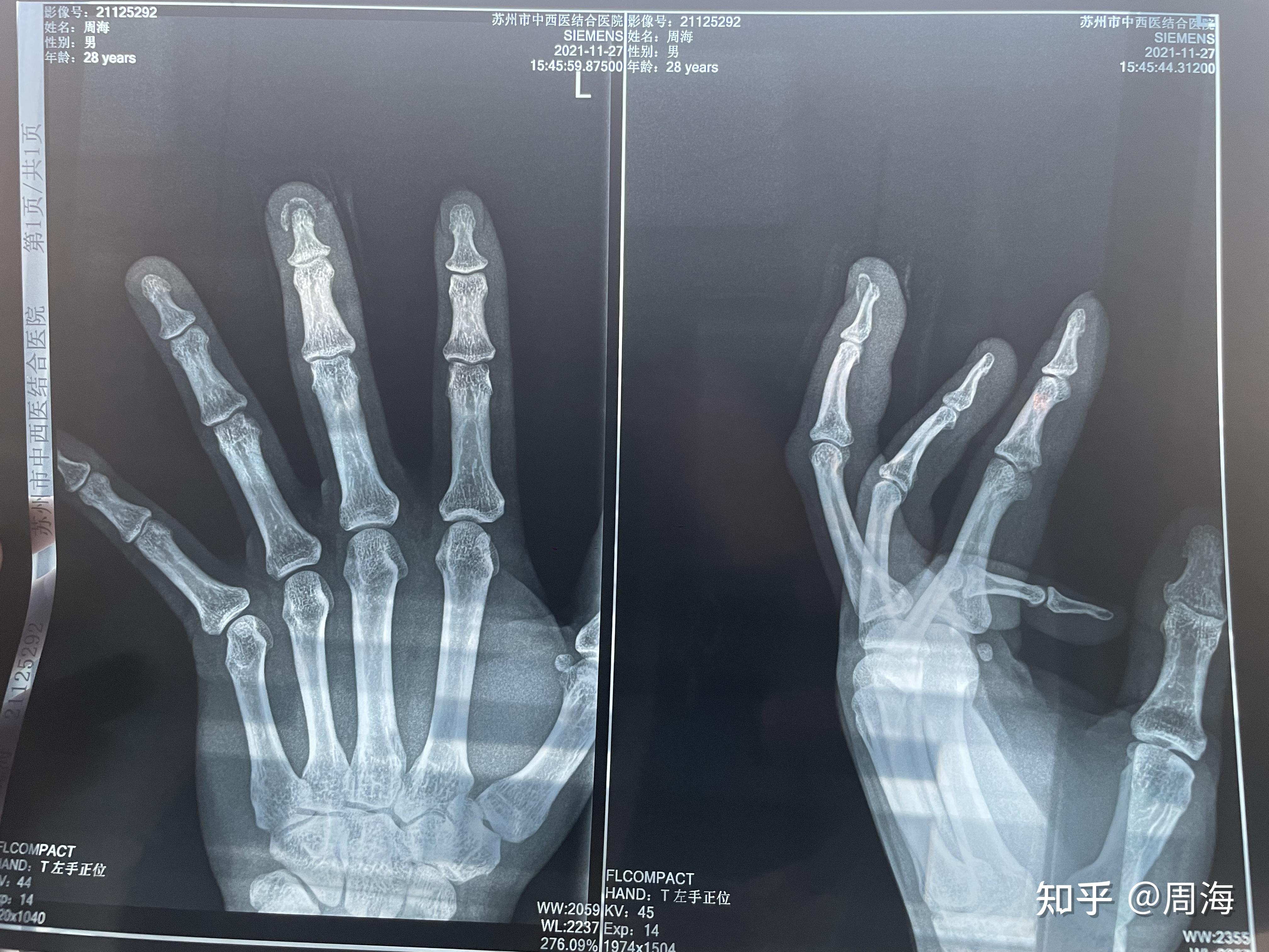 左手中指末节指骨骨折能评上十级工伤吗?