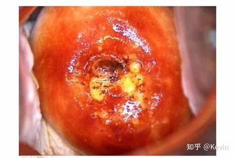 人乳头瘤病毒(hpv),感染了hpv就是"不检点"吗?