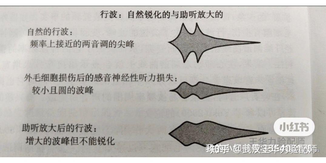 Explain Hearing Impairment Explain Hearing Impairment