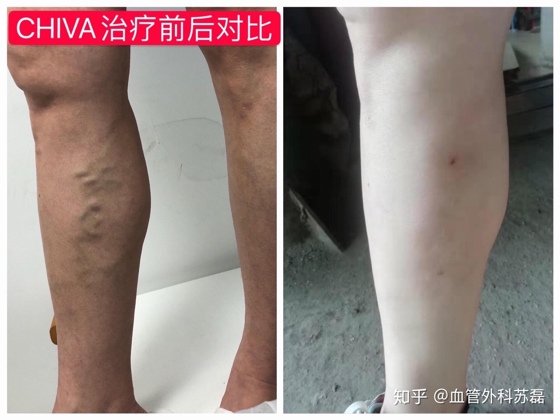 静脉曲张手术治疗效果图