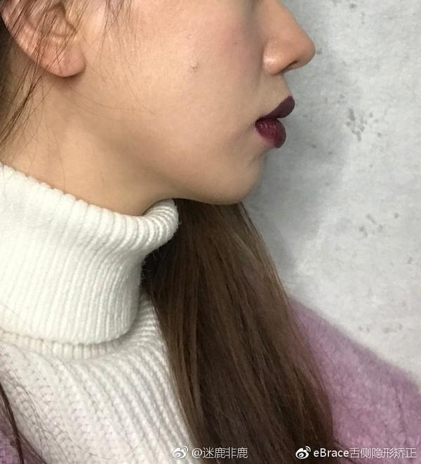 脸凸,骨性前突亲身挑战舌侧隐形牙齿矫正!侧颜已经有变化啦!