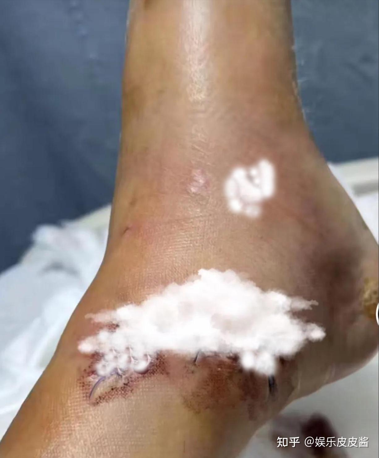 左脚受伤打钢钉,自嘲:还好脸没事 - 知乎