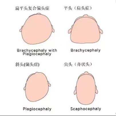 新生儿宝宝怎么睡出漂亮的小圆头?头型扁了如何矫正? - 知乎