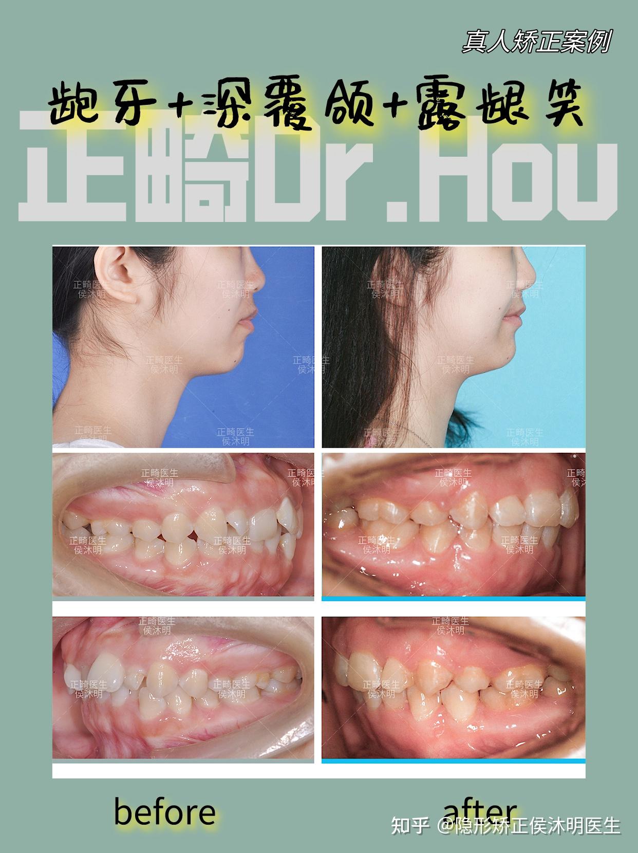 北京牙齿矫正|牙齿不齐+嘴突+露龈笑-案例分析合集 - 知乎