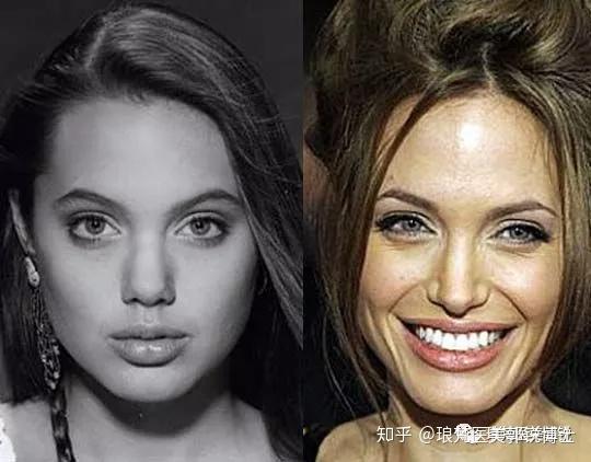 整后确实美多了.寡姐的缩鼻子手术.miley cyrus 的缩鼻手术.