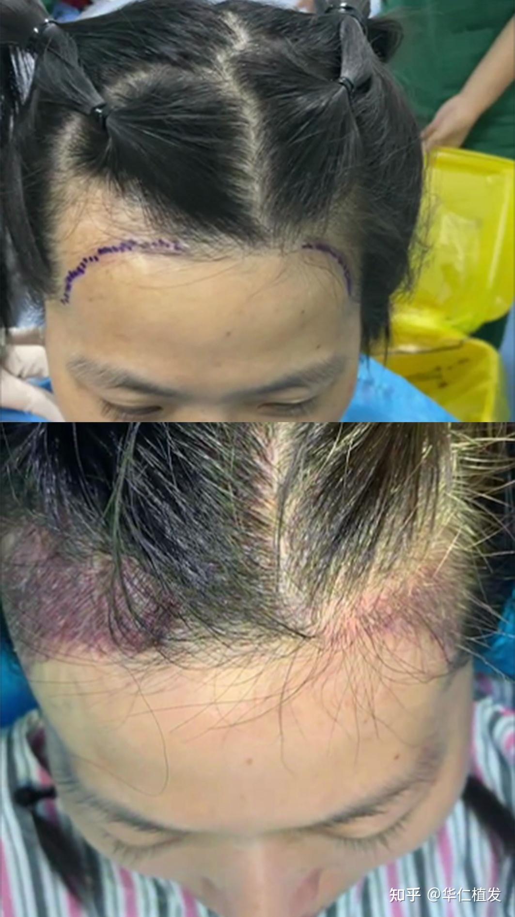 植发科普丨植发后可以维持多久? - 知乎