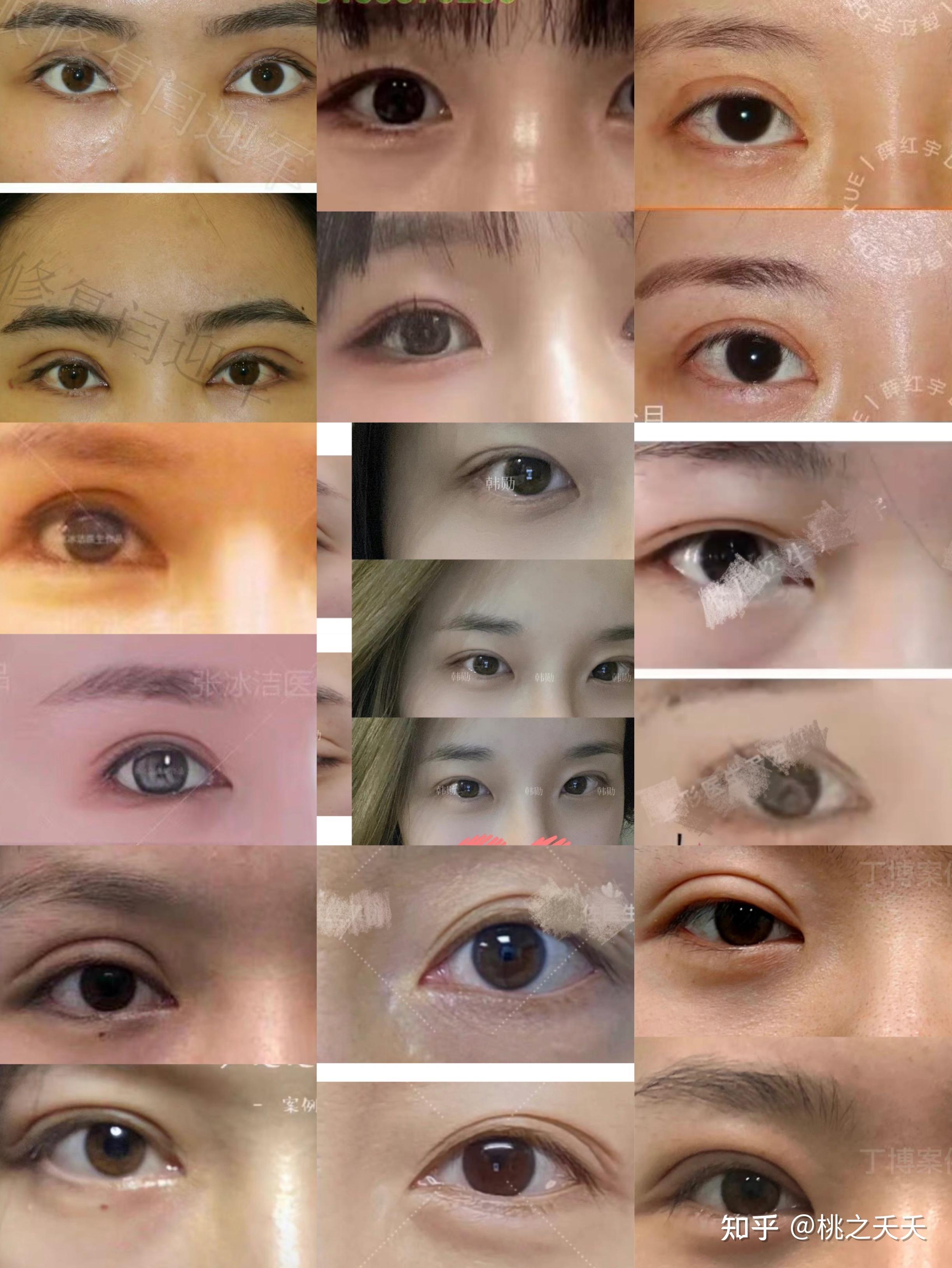 [cp]中国最好的双眼皮眼部整形眼修复专家：闫迎军（简介、案例、预约） - 知乎