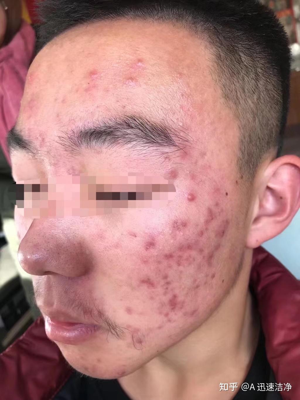 痘痘痤疮终于好了