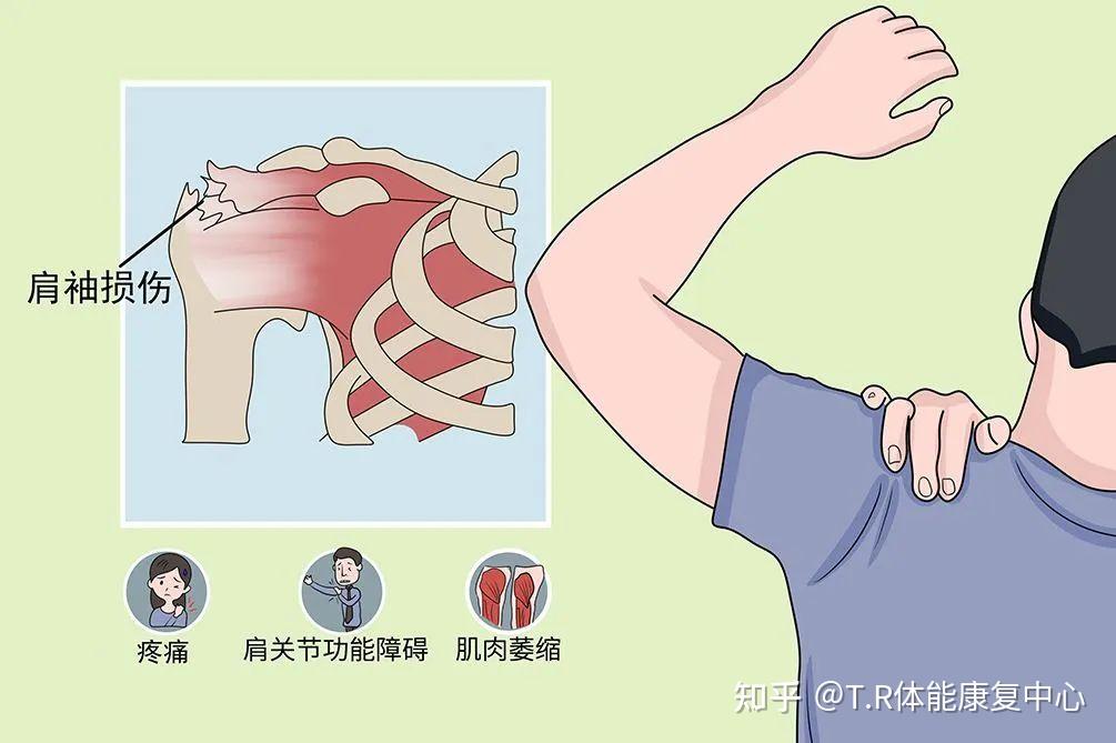 肩袖損傷康復訓練計劃