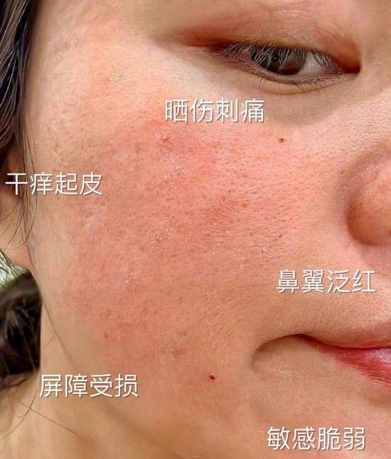 女生敏感肌护肤脸上容易长红血丝干痒刺痛起皮敏感肌肤如何正确护肤