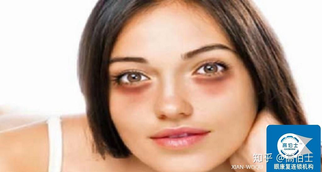 眼部黑眼圈是怎么回事