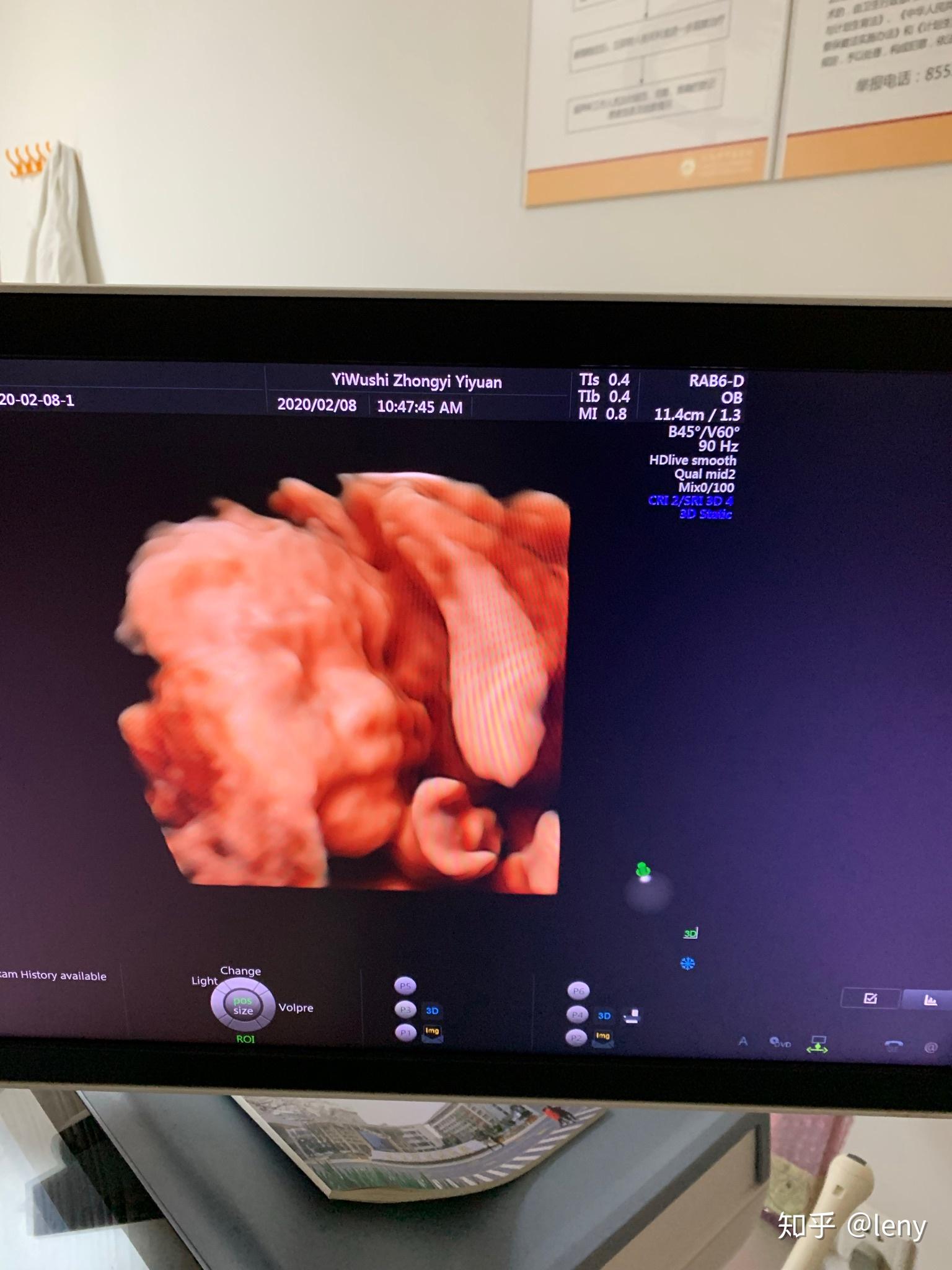 你第一次看到宝宝的四维彩超照片是什么感觉