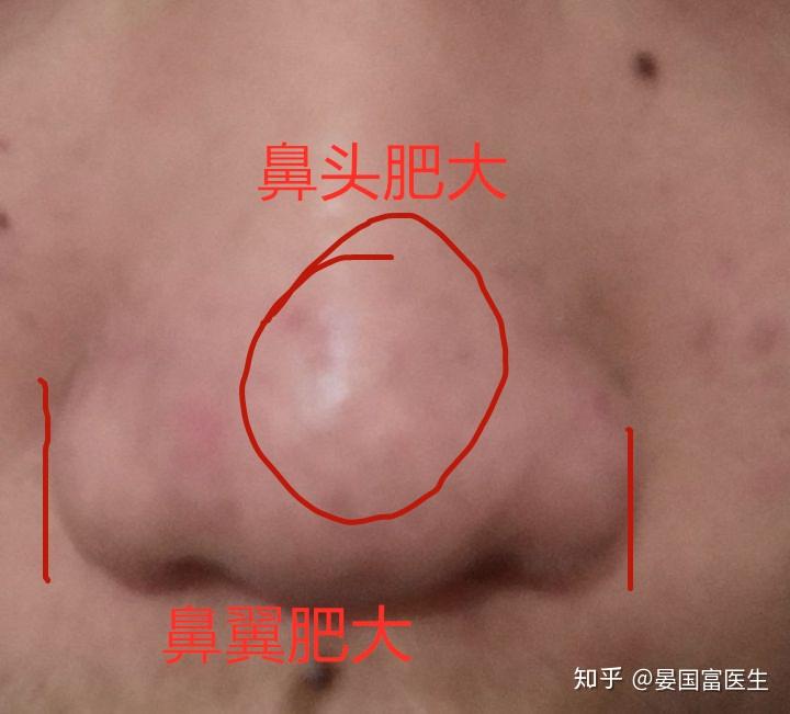 怎么样才能改善鼻子 v2-e0cf75de127bf09be7030a446079e6a6_r.jpg