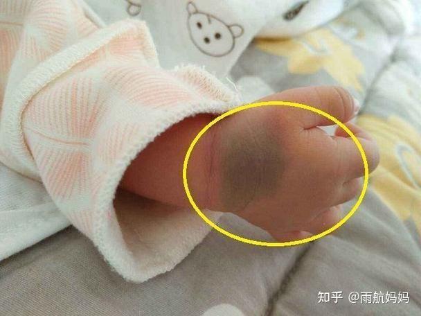 新生儿蒙古斑：原因、科普和注意事项 知乎