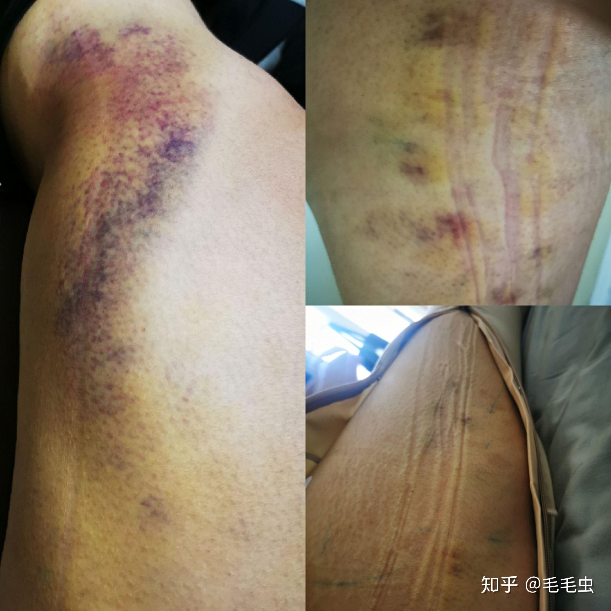 大小腿吸脂手术全记录