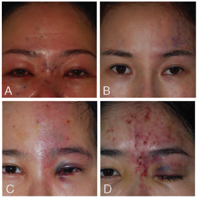 抽脂可能导致脂肪栓塞还有哪些让人眼红的操作其实暗藏高风险