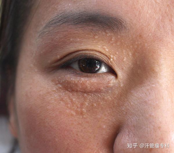 长汗管瘤的患者饮食应该注意什么