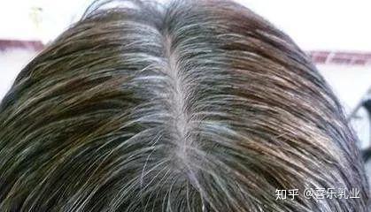 40岁长白发吃什么调理 吃5种食物白头发变黑 三个部位长白发最危险 40岁长白发吃什么调理 吃5种食物白头发变黑 三个部位长白发最危险