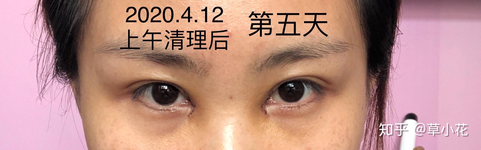 开眼角内眦赘皮记录