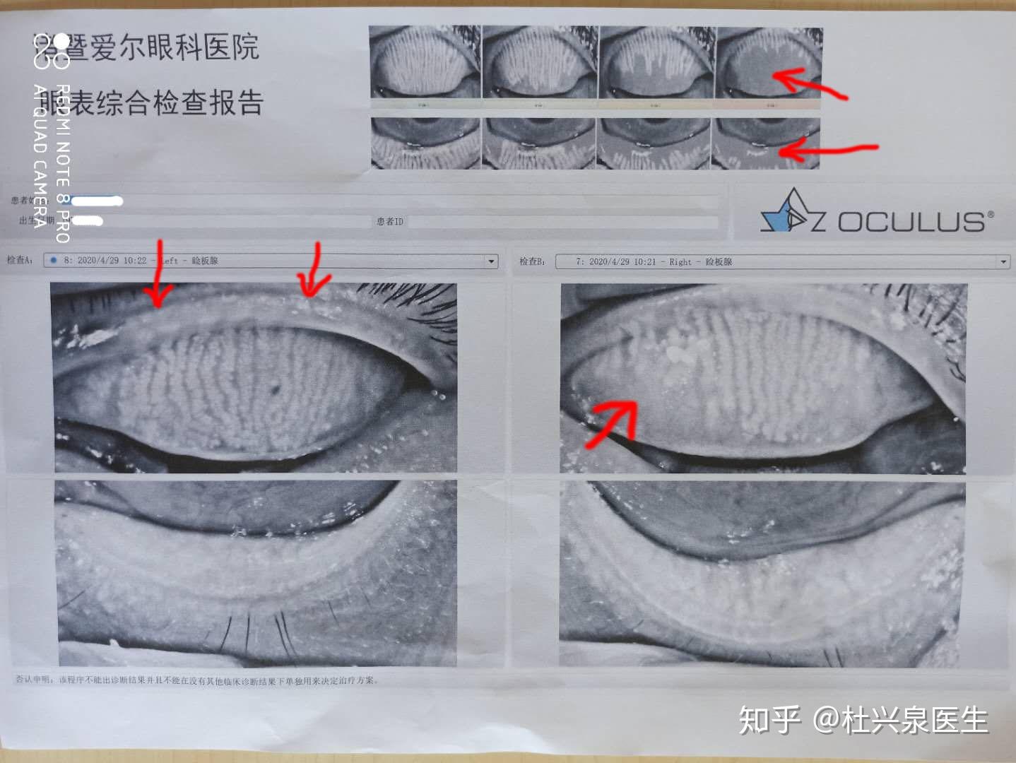 图1-10 双侧麦粒肿。下睑红肿-眼前节疾病-医学