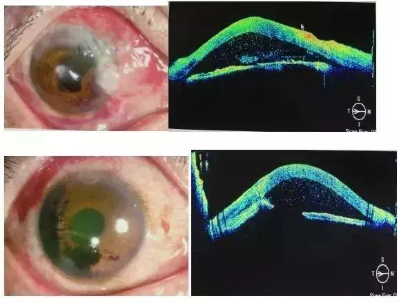至2016年1月诊治的角膜穿孔伤连续病例55例(55只眼),排除患有圆锥角膜