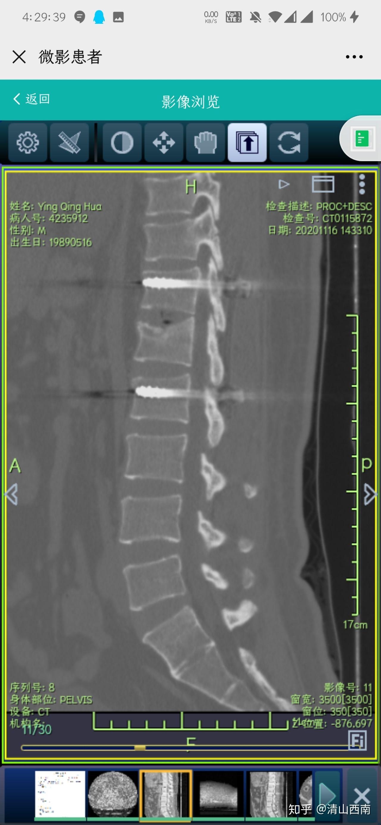 腰椎l1压缩性骨折术后ct图 