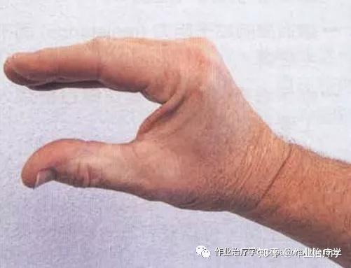 蚓状肌抓握