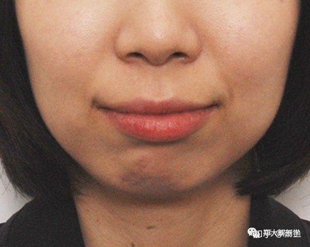 肌上部的肌纤维水平走行,与口轮匝肌下缘交织在一起形成一个连续结构