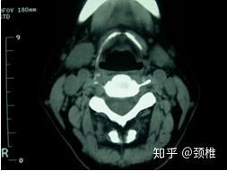 一个颈椎病锻炼康复患者对颈椎病知识的整理及