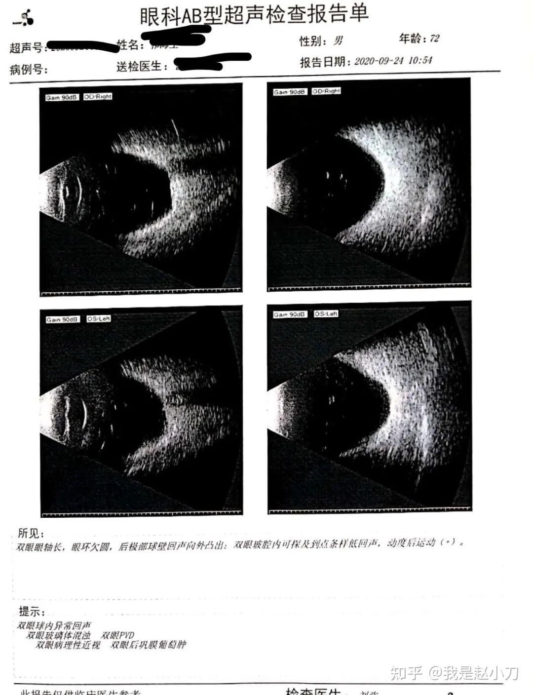 图2-17 多发胆囊息肉并胆囊结石声像图-腹部超声简易-医学