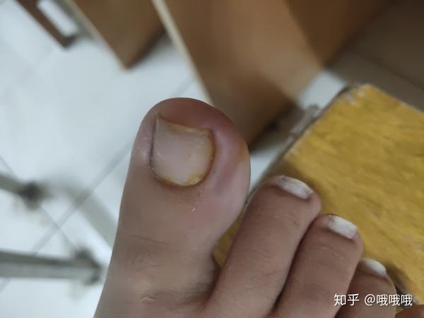 甲沟炎化脓出血怎么办？