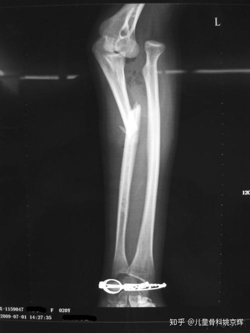 医生monteggia在1914年最早报道此类骨折,所以也称之为monteggia骨折