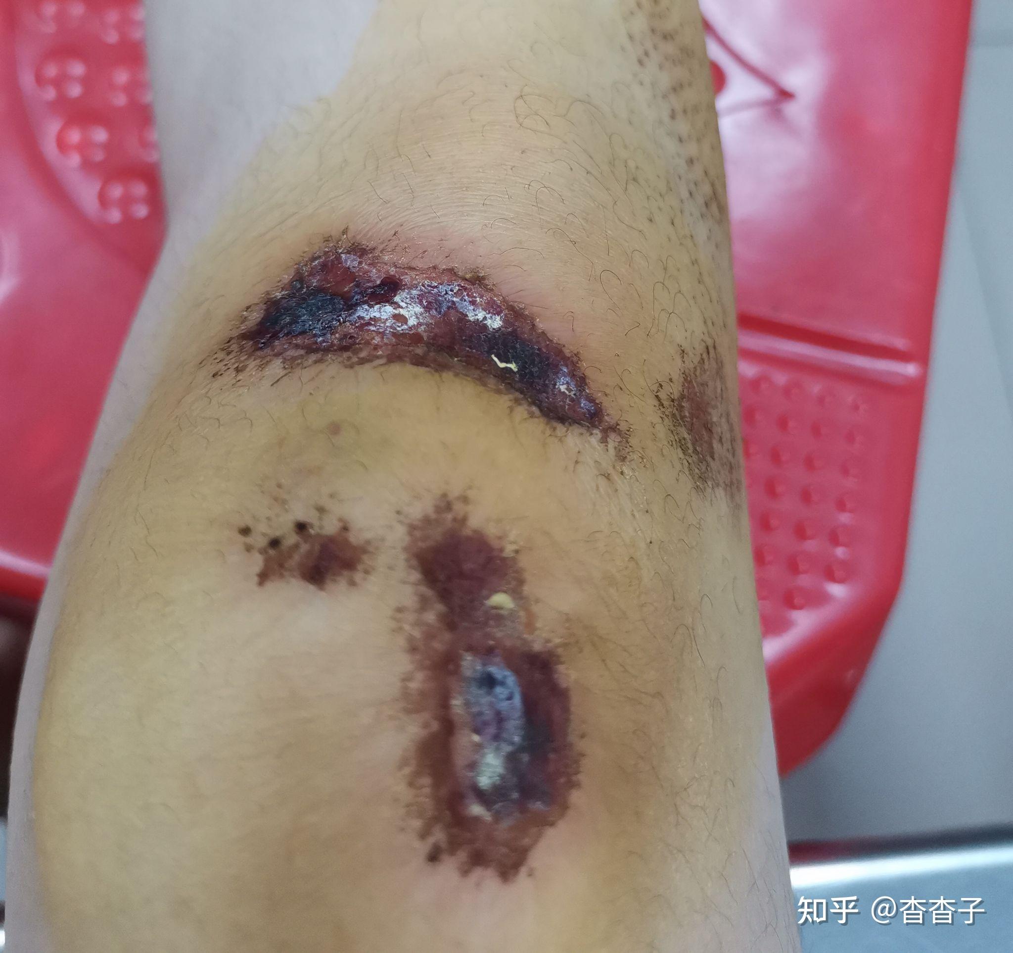 伤口愈合过程是怎样的?