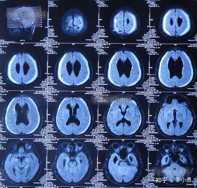图-9:2015年4月2日头颅ct图-8:2015年3月30日头颅ct脑积水腹腔分流术