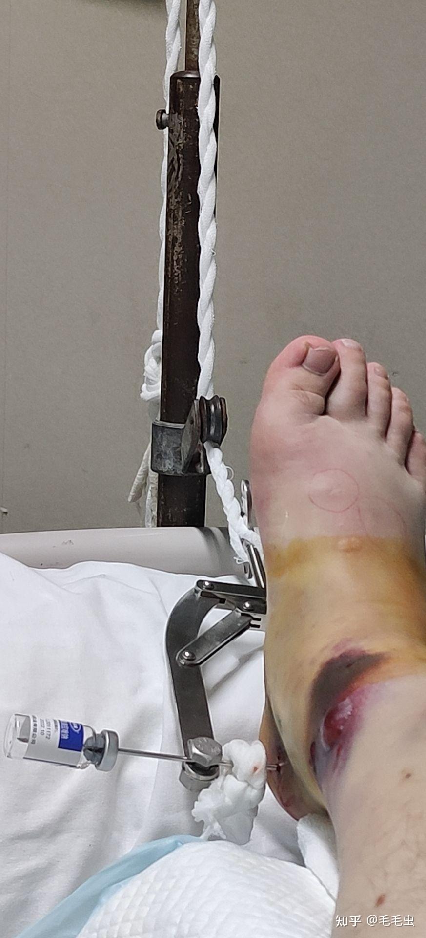 第二篇骨折躺在眼科病房难熬的20个小时