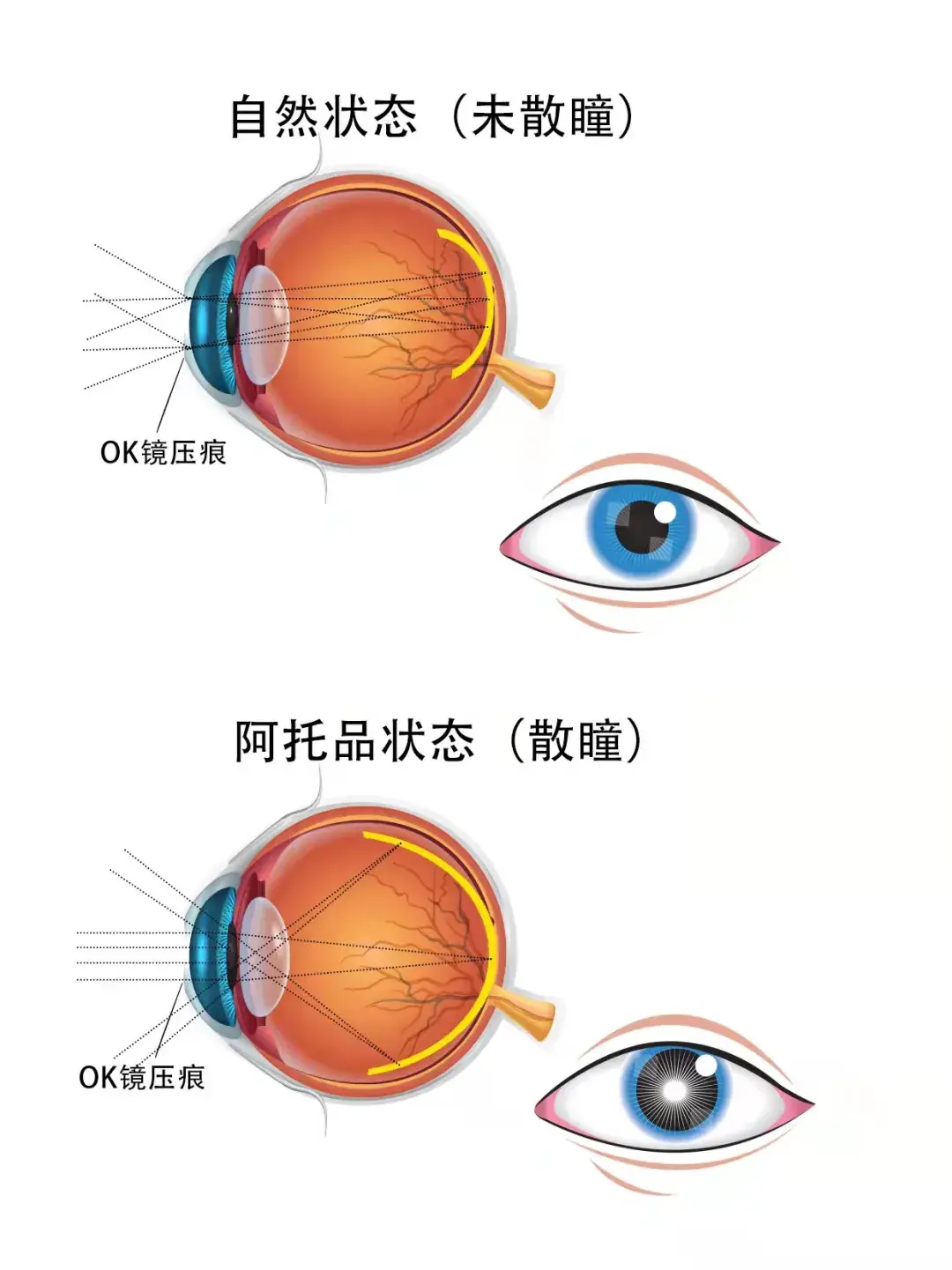 使用阿托品白天畏光？眼部该如何防御紫外线？ - 知乎