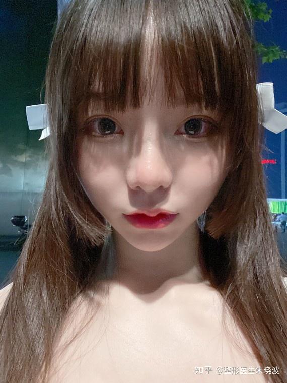 【案例分享】M唇手术,性感可爱萌到炸的M唇 - 知乎