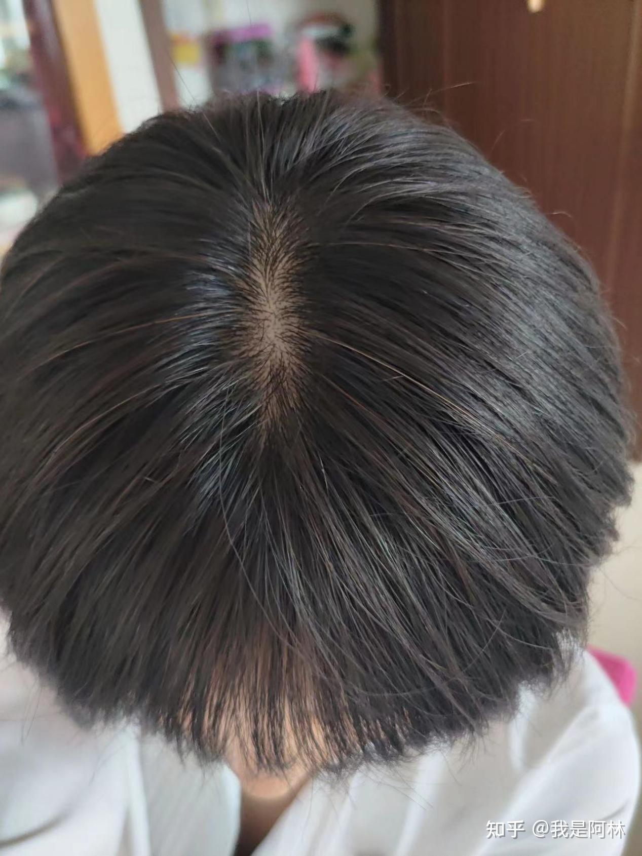 白头发好明显啊,巨显老!不想再染了,有没有能彻底解决白发的办法? - 知乎