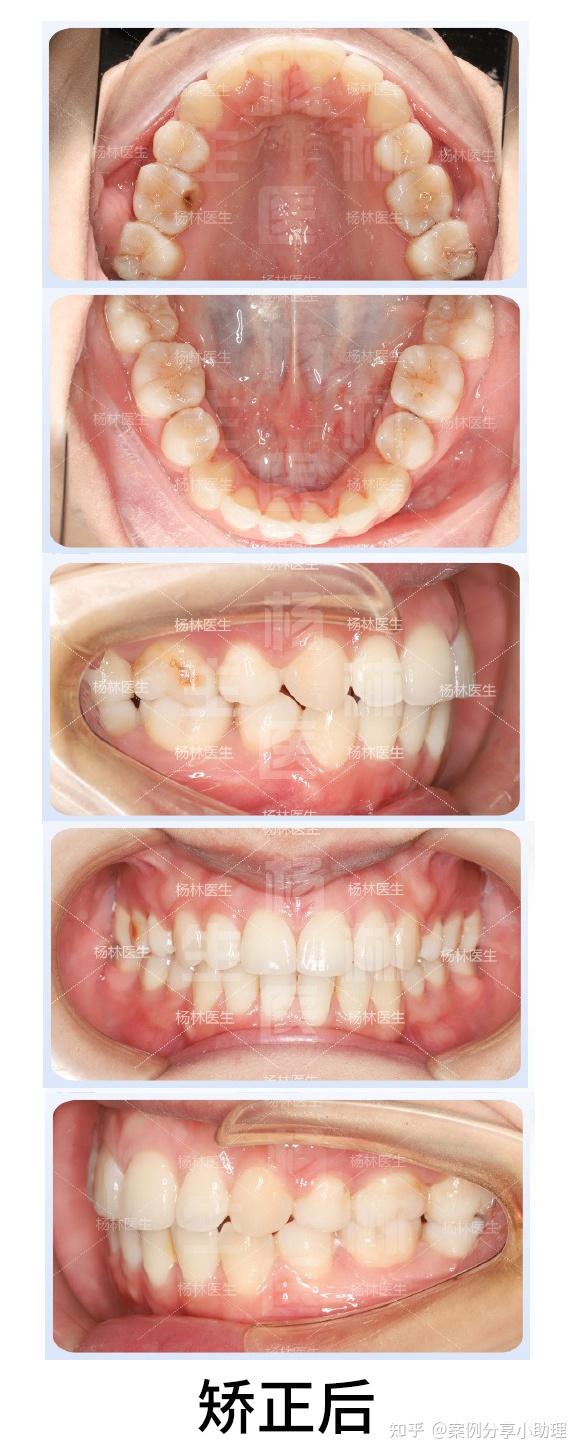 正畸案例分享丨骨性Ⅱ类嘴巴前突矫正