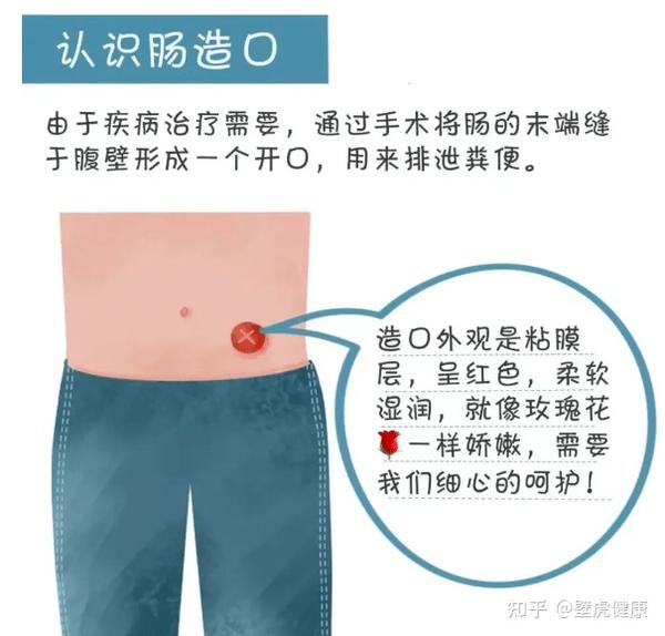 格尔护士:造口人日常居家如何护理?这份“造口干货”好好收藏! - 知乎