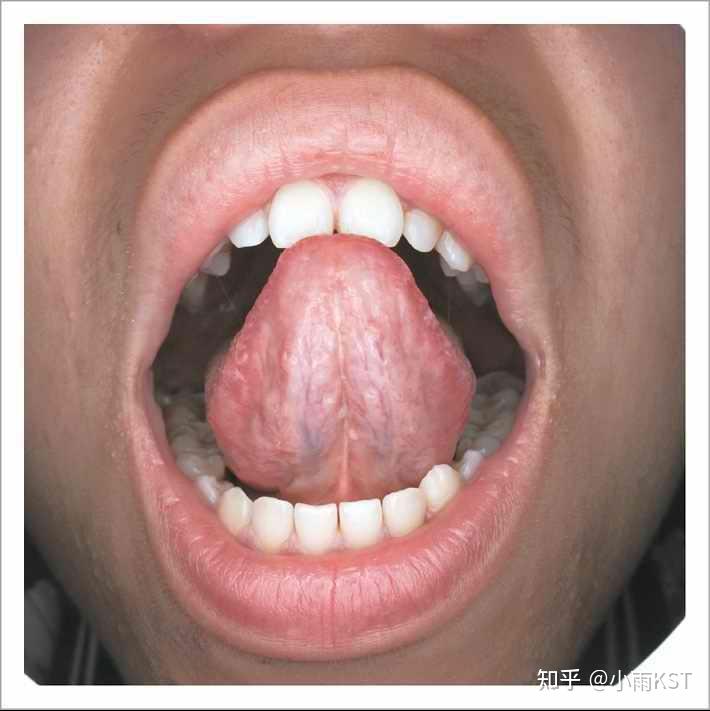 正常人的舌头图片