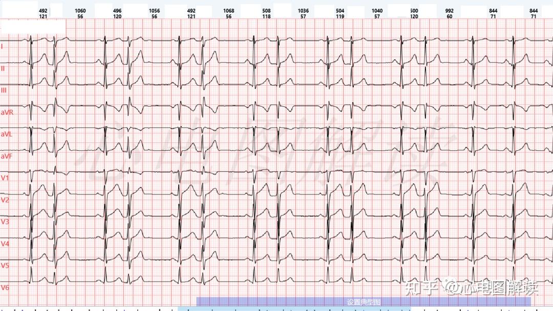 房性早搏二联律