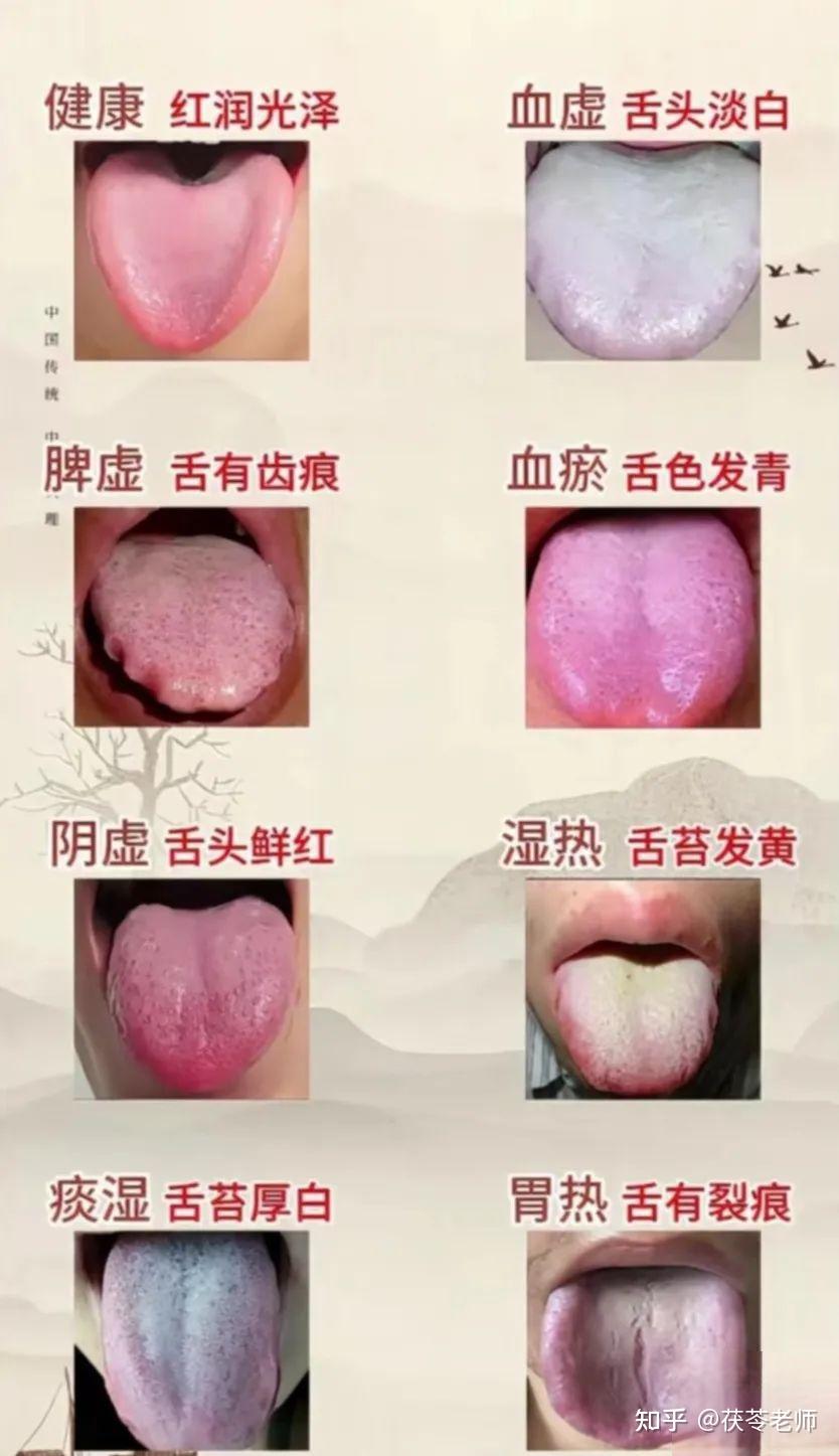 九种舌相裂纹,你属于哪种? - 知乎