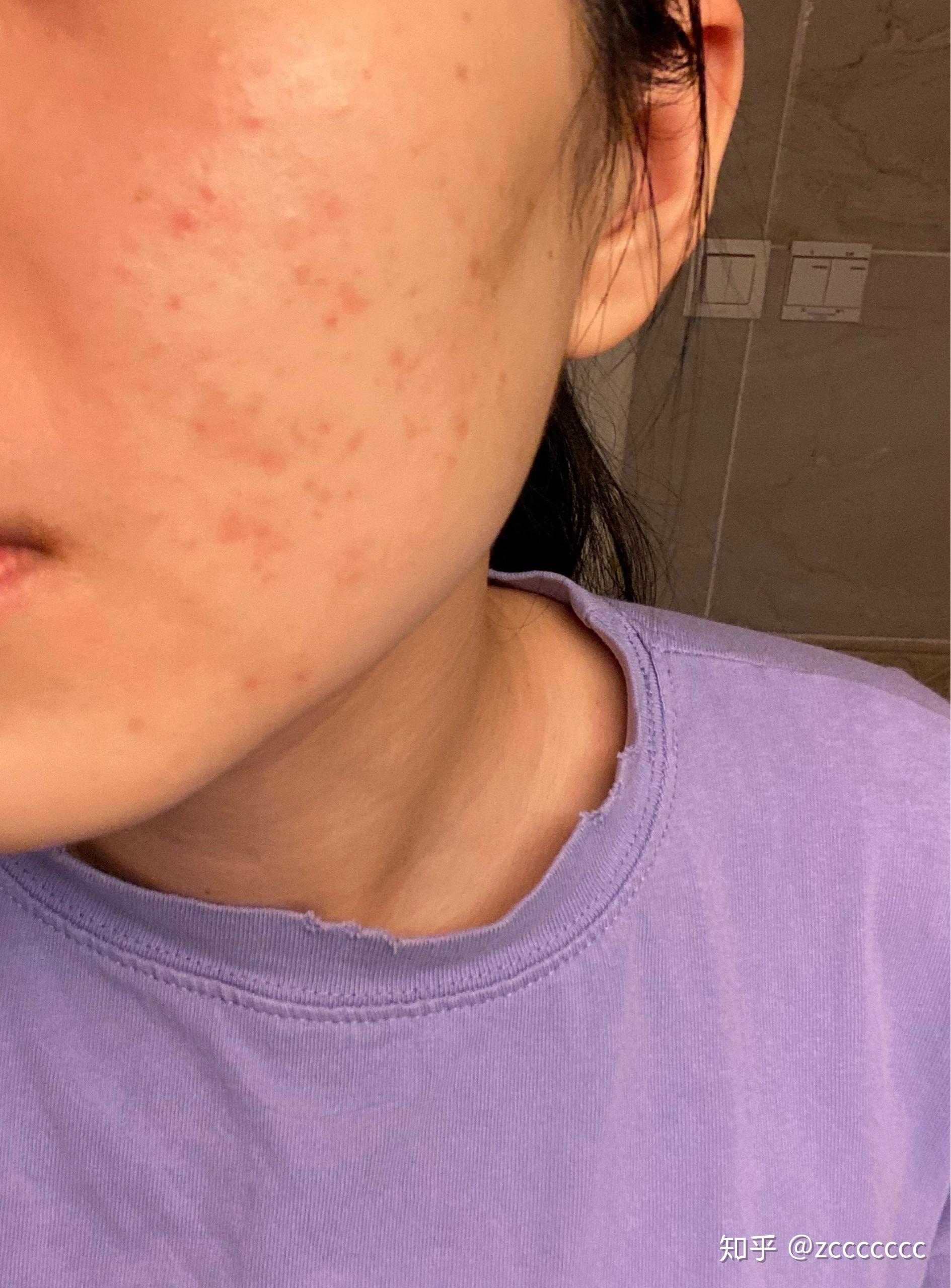 维a酸乳膏使用日记