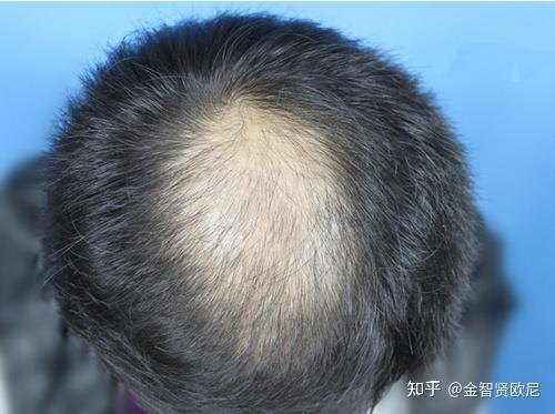 关于植发的99个问题汇总,你想知道的植发信息都在这里了(持续更新) - 知乎