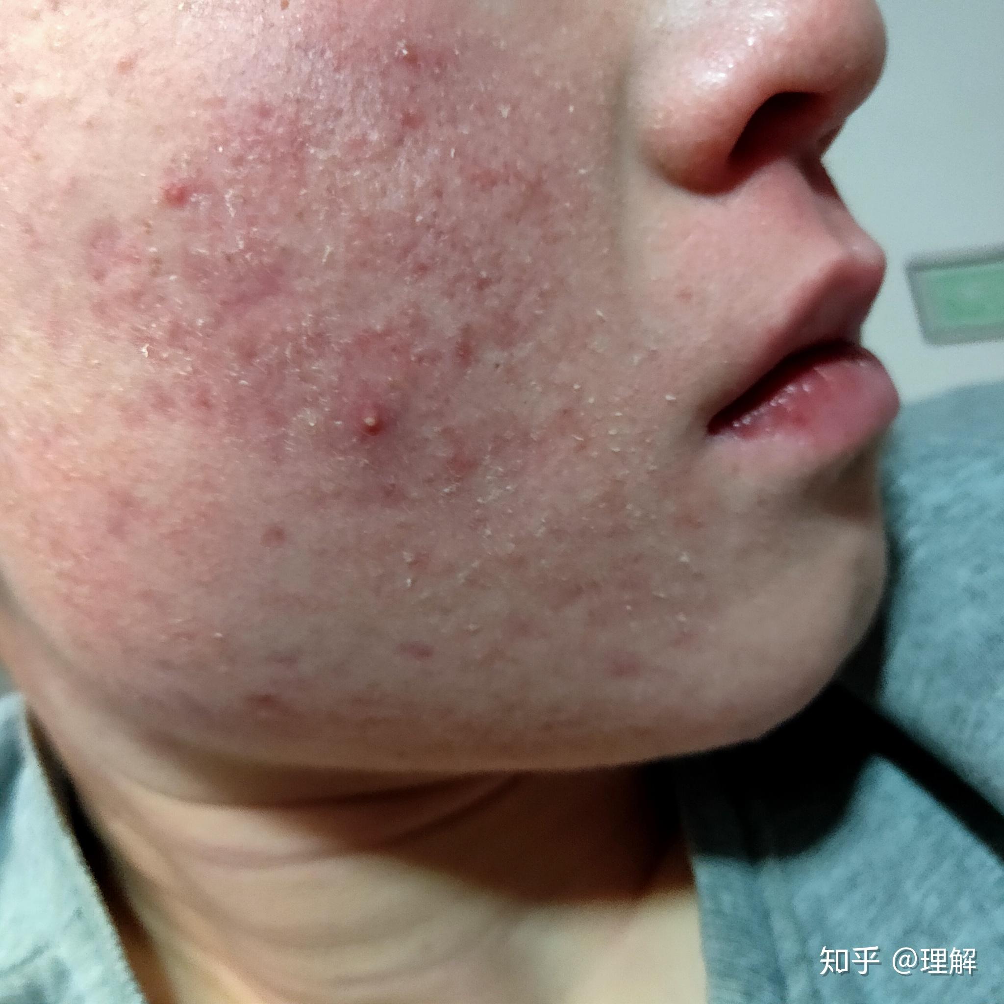 异维a酸软胶囊泰尔丝记录篇