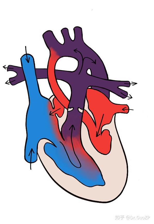 聊聊先天性心脏病左心发育不良综合征