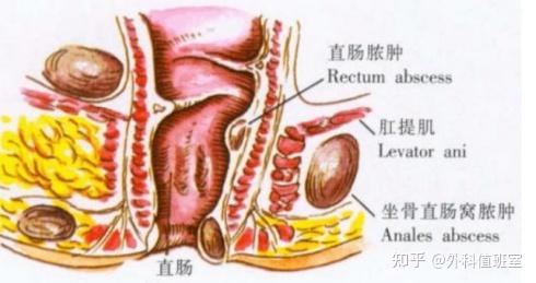 肛瘘的危害和预防方法