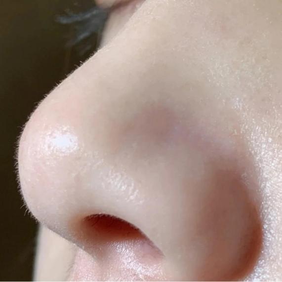 如何有效去除鼻子上的黑头?