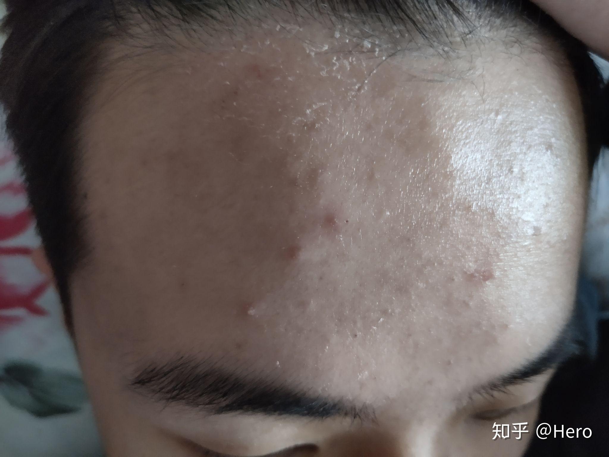 头皮这是什么情况啊干燥起皮摸起来硬硬的